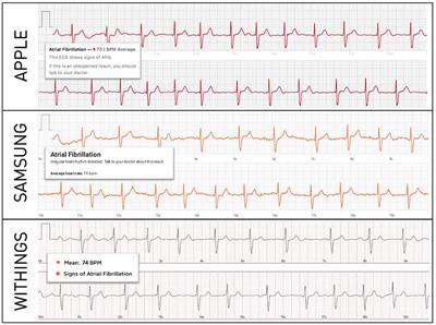 Smartwatch Electrocardiograms for Automated and Manual Diagnosis of Atrial Fibrillation: A Comparative Analysis of Three Models